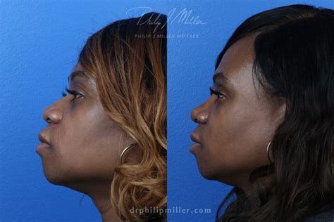 african american nose bridge.